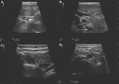 Application of high-frequency ultrasound in the diagnosis of gastrointestinal magnet ingestion in children